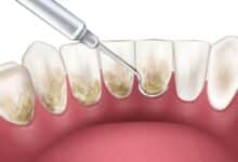 teeth cleaning frequency