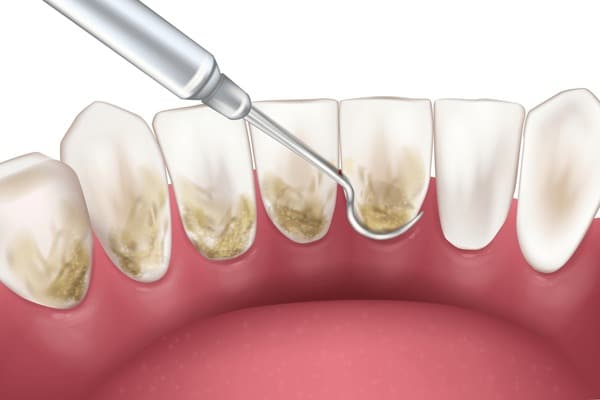 teeth cleaning frequency